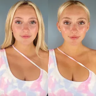 This is after one Hydro facial with lymphatic drainage.