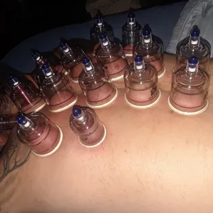 Cupping therapy