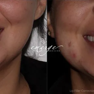 Lip filler correction Before/After