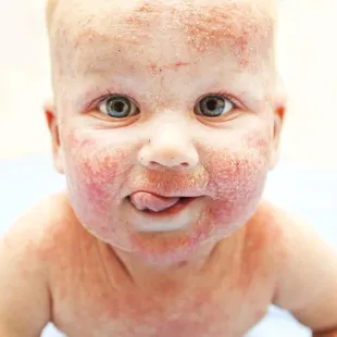Studies have linked eczema with hard water and chlorine.