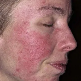 Skin conditions like eczema can be improved with treated water.