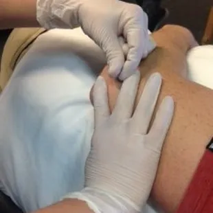 Dry Needling to decrease elbow pain.