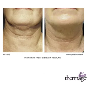 Thermage CPT tightens skin. Non-invasive and only one treatment needed.
