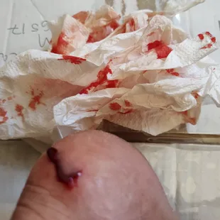 Screen door slammed on my heel from sharp edge with no guard or air cylinder to prevent quick shutting . I sustained a flap laceration .