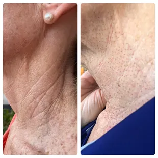 1 week post Fibroblast