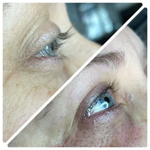 Fibroblast Skin Tightening