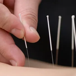 Acupuncture with needle or needless acupuncture