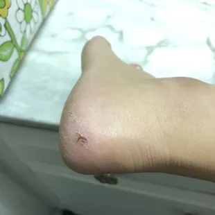 My heel a week after pedicure. Still gives me pain when I walk on it. Never going here again!