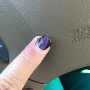 This Is what you get when you go to this place. 2weeks later a strong anabiotic 4times a day and extra penicillin shot and a bad infection