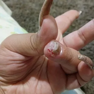 My finger literally burst open from the infection