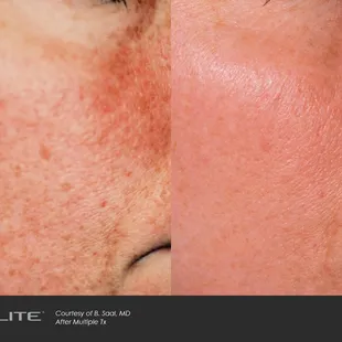 treat hyperpigmentation Victoria, TX