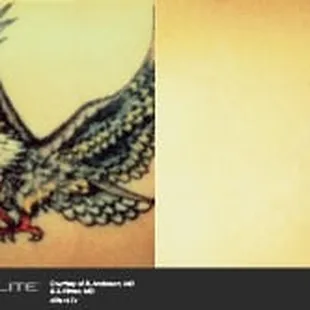 tattoo removal Victoria, TX