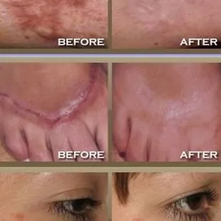 scar fading Victoria, TX