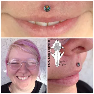 Healed philtrum with a black opal gem