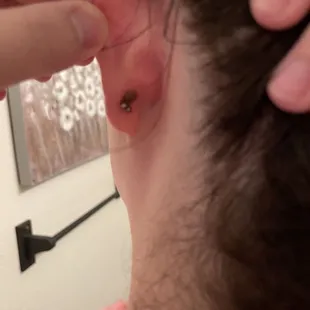 (TW) Discharge from ear