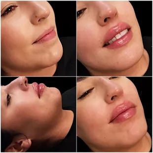 Lip fillers.