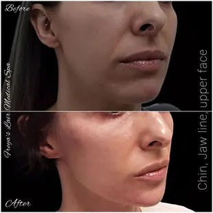 Jaw line and chin augmentation.