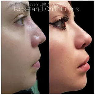Non surgical nose fillers.