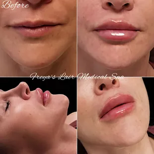 Beautiful lip fillers. Nude Technique.