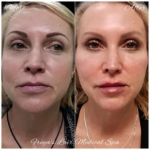 Full face remodeling. &quot;MD codes&quot; technique.