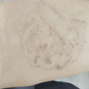 Tattoo that is being removed.