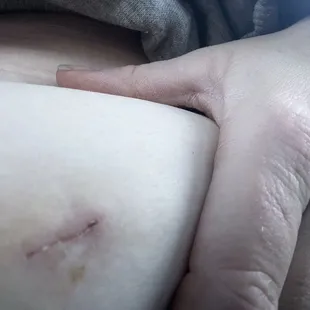 One of the incisions