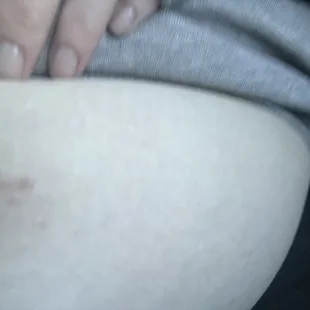 Other incision