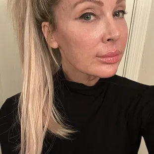 2 weeks post treatment with Matrix RF Microneedling and Ultraclear Erbium Laser.