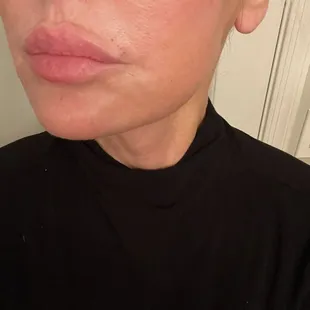 5 months post treatment with Matrix RF Microneedling, Ultraclear Erbium Laser and Juvederm Dermal Filler.