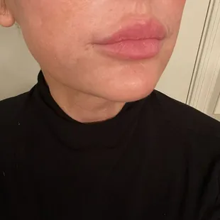 5 months post treatment with Matrix RF Microneedling, Ultraclear Erbium Laser and Juvederm Dermal Filler.
