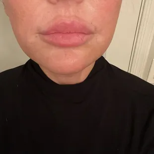 5 months post treatment with Matrix RF Microneedling, Ultraclear Erbium Laser and Juvederm Dermal Filler.