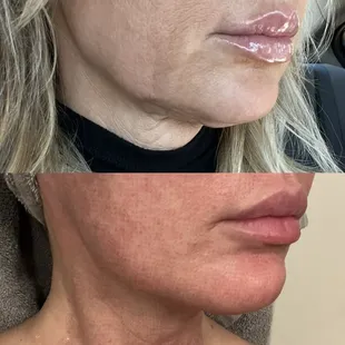 Before and after 5 days post treatment with Matrix RF Microneedling and Ultraclear Erbium Laser.