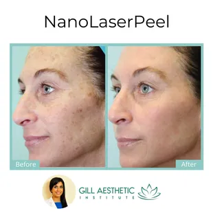 Get ready for incredible skin with this laser resurfacing treatment!
