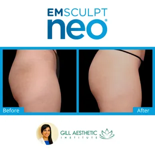 EmSculpt Neo Before and After!
