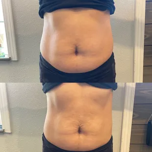 Before and after midsection slimming one session