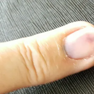 Happens when finger tip caught in defective chair