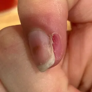 After I got my infection drained