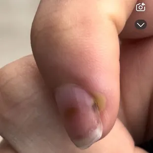 The start of my nail getting infected