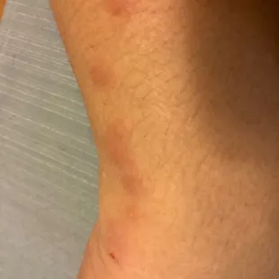 Some of my bites from the bed bugs...
