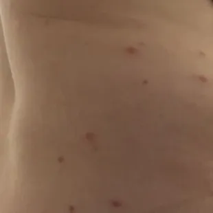Fucking bed bugs. Both of my sides have this same pattern. I am so disgusted.