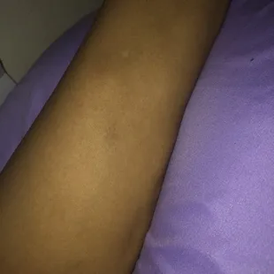 The bruises the lady left on me while grabbing my arm to come inside as she demanded a tip. I cannot make this up.