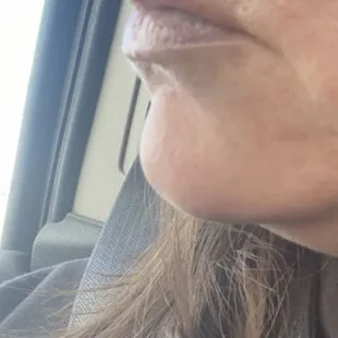 Right after lip fillers