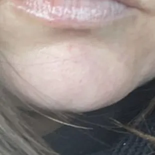 Right after lip fillers