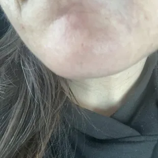 Right after lip fillers