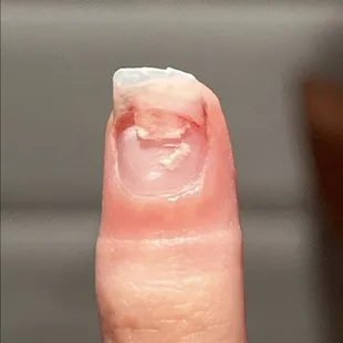broken nail