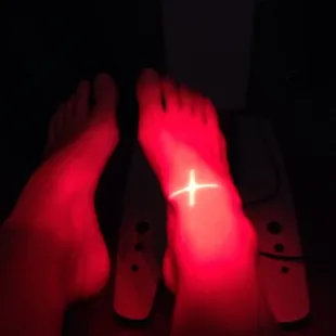 Lazer treatment on right foot