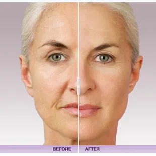 Say goodbye to your wrinkles with Juvederm injectable gels made from a naturally occurring sugar found in the human body.