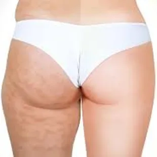 Troubled by cellulite?  You don&apos;t have to live with it!  Reduce the appearance in 16 weeks with Endermology, a clinically proven technique!