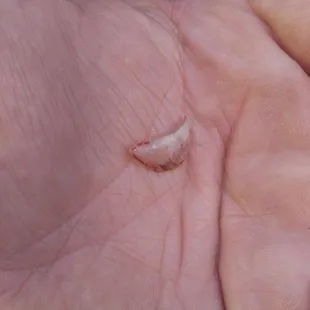 a hand with a piece of skin on it