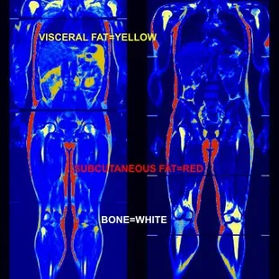 Holland Clinic offers state of the art DEXA scanning through Body Math